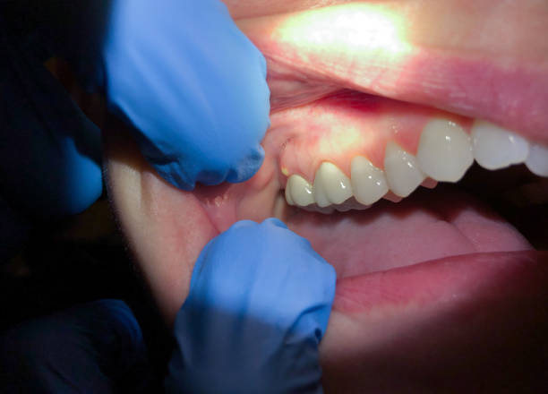 Best Dentist for Tooth Abscess  in Washington Park, FL