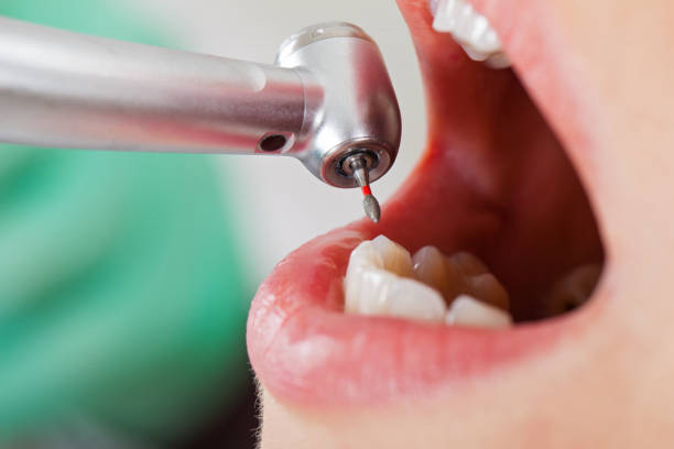Best Root Canal Emergency Dentist  in Washington Park, FL